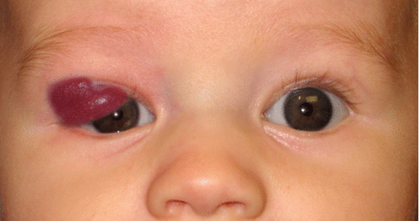 Time Lapse photographs of patient treated with topical timolol for capillary hemangioma